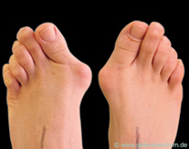Abbildung 1: (vor OP): Fuß Hallux Valgus